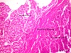 Histopathology-Gastroduodenal intussusception